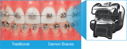 damon braces compared to traditional braces