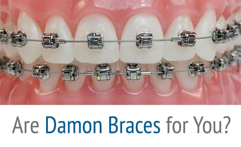 Jennings Orthodontics Houston Offers Self Ligating Braces by Damon System