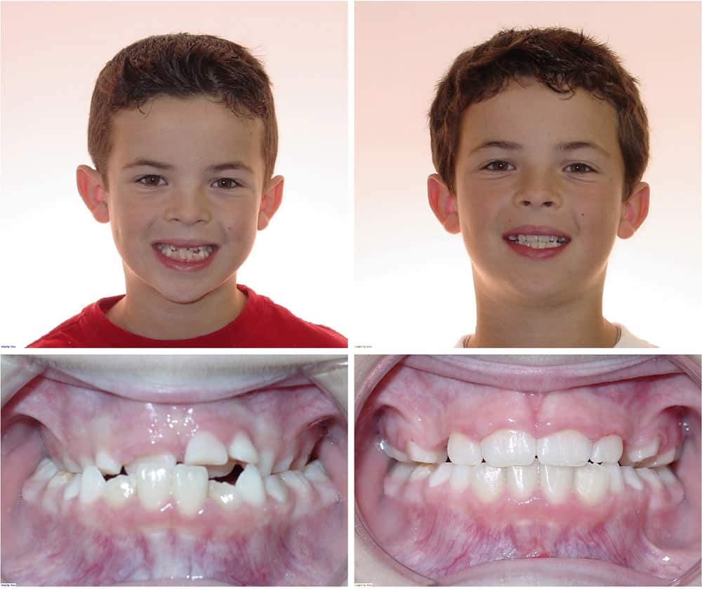 Houston Damon Braces - Anterior Crossbite