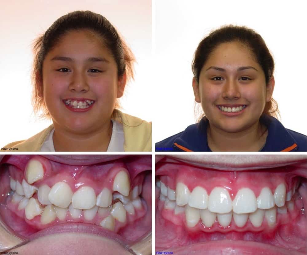 Houston Damon Braces Crowding Extractions