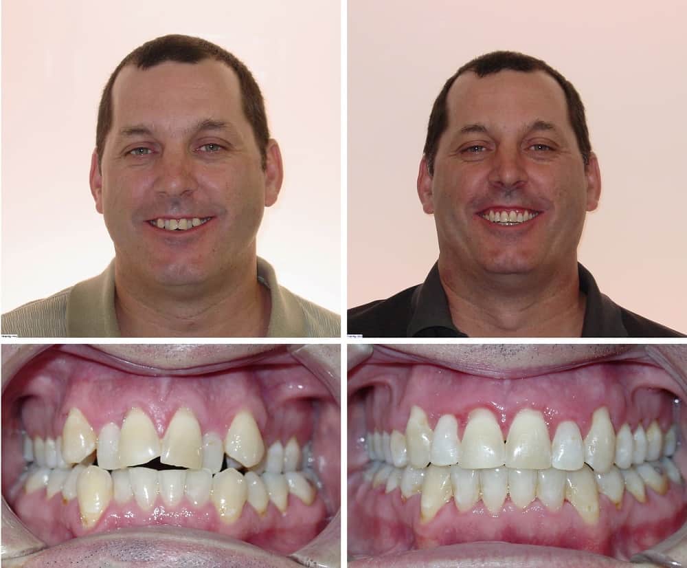 houston-damon-braces-crowding-non-extraction