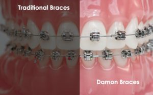 Comparison Between Traditional Braces and Damon Braces - Jennings ...